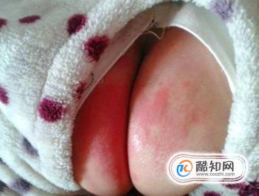 如何护理新生儿的红屁股？