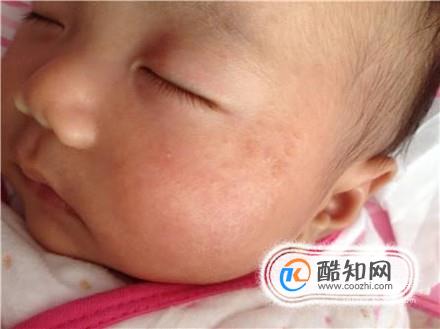 婴儿脸部红色斑点（婴儿痤疮）的护理