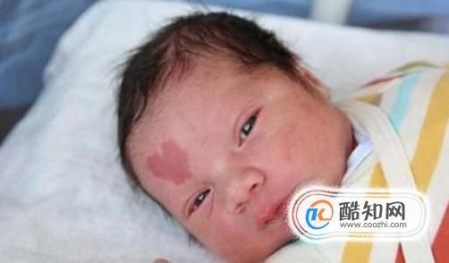 新生儿常见胎记辨别大全