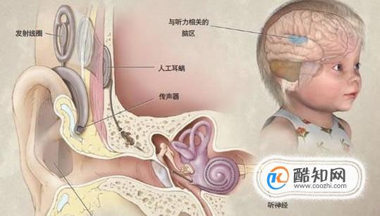 助听器和人工耳蜗的区别